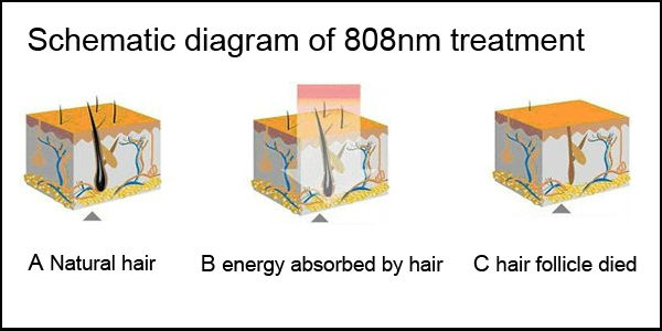 hot 808nm dioda laser rambut alma harmoni