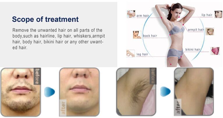 Profesional 808nm Diode Laser / 808nm Removal Diode Laser Hair / Laser Hair Removal Mesin